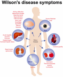 Wilson Disease Symptoms, In Wilson disease the symptoms are highly variable and can affect liver, brain, kidney, eyes, heart, bone, blood system, and many other organs or tissues. by Mirror Gene a Genetic Counseling service