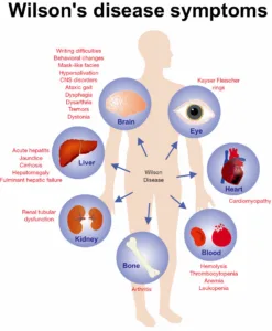 Wilson Disease Symptoms, In Wilson disease the symptoms are highly variable and can affect liver, brain, kidney, eyes, heart, bone, blood system, and many other organs or tissues. by Mirror Gene a Genetic Counseling service