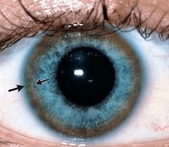 Understanding Wilson Disease, Genetic Perspective kayser-fleisher rings